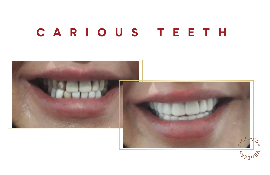 snap on veneers