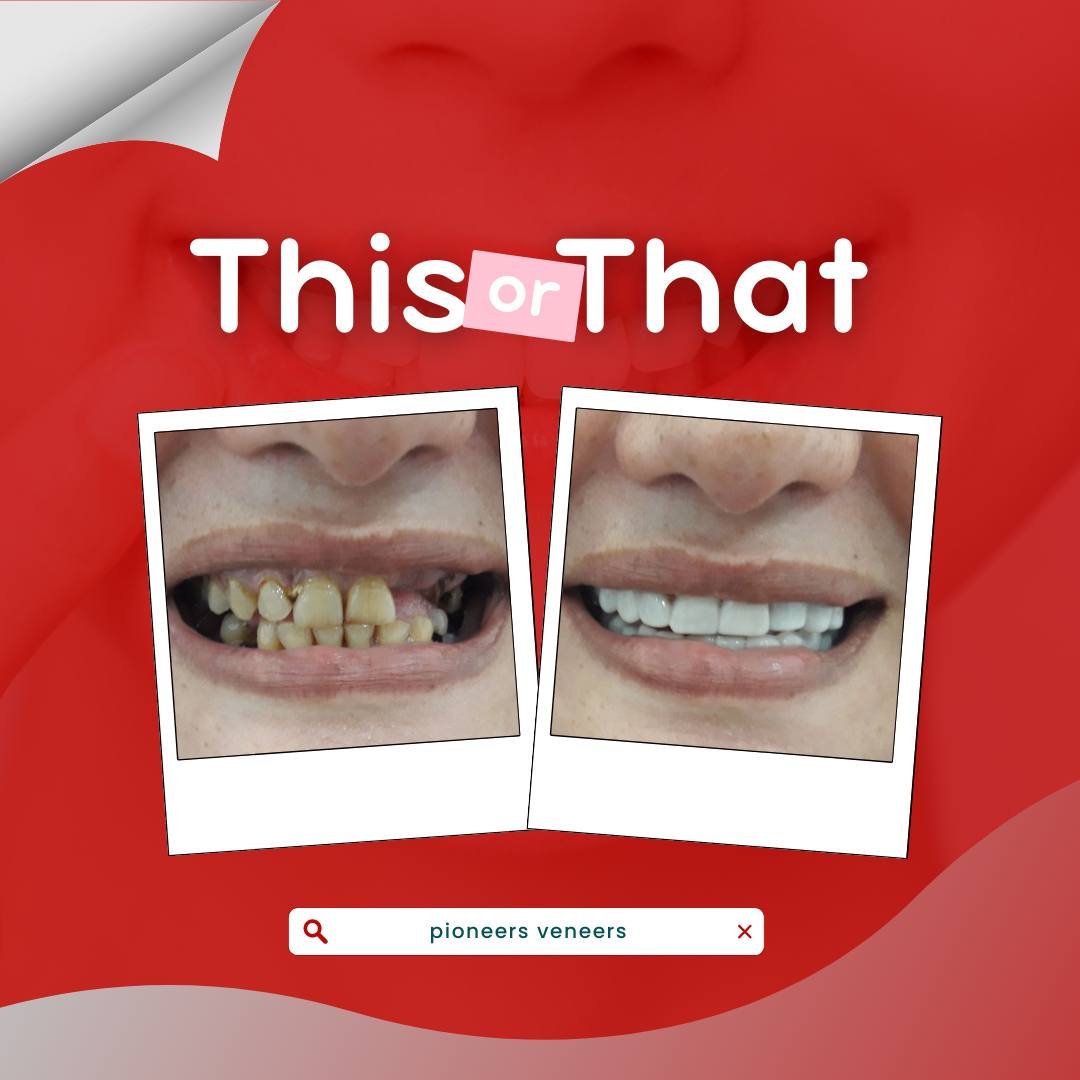 Snap-On Veneers 117: Busting Myths &amp; Uncovering the Beautiful Truth!