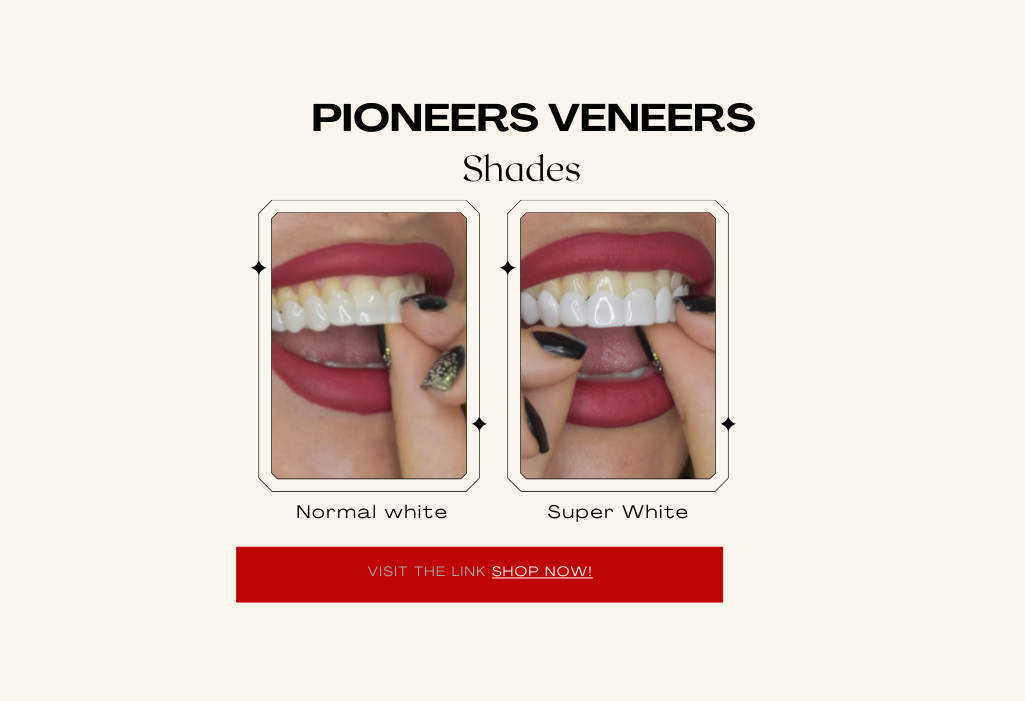 Snap-on veneers