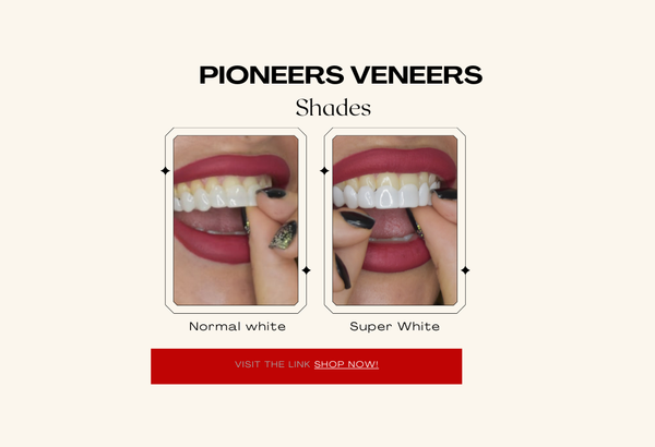 Snap-on veneers