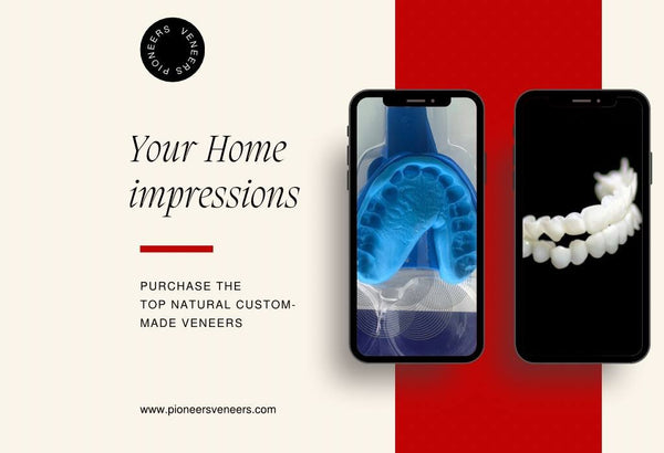 Snap on veneers impressions