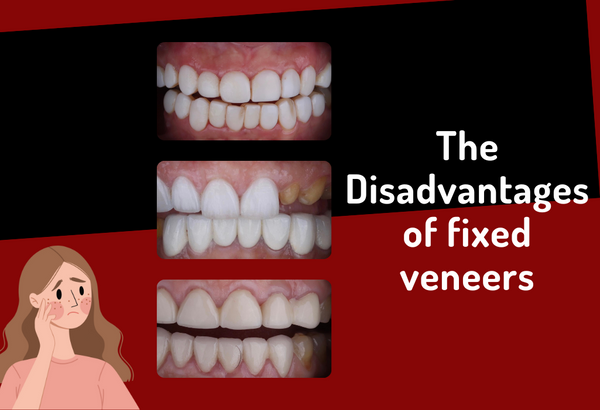 The Bad Effect of Having fixed veneers