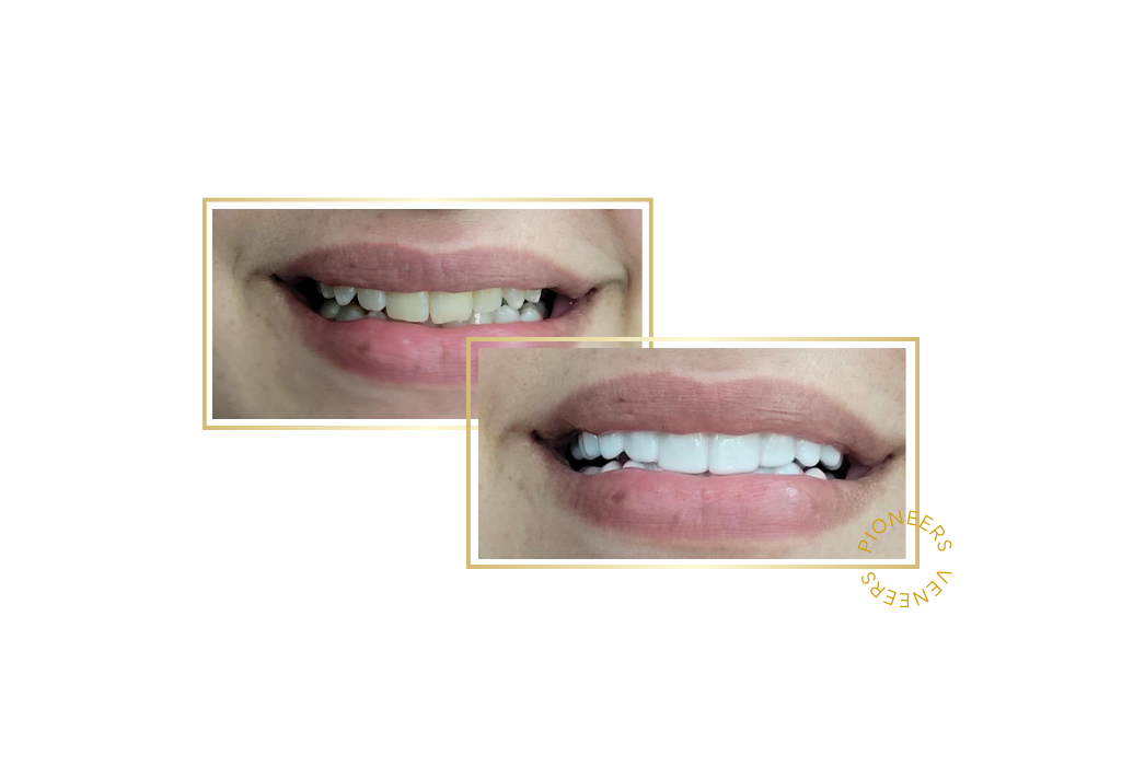 Snap on Veneers