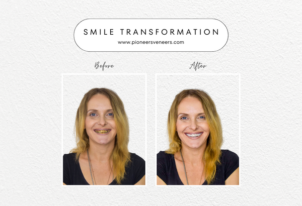 Wear Snap on veneers every day enjoy a new Smile