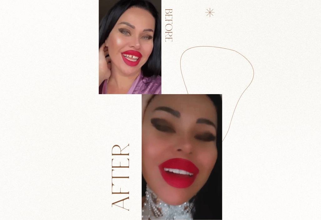 best snap on veneers 2021