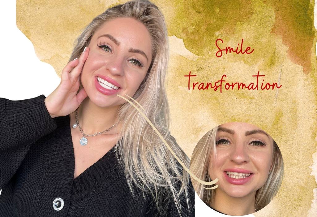 smile transformation