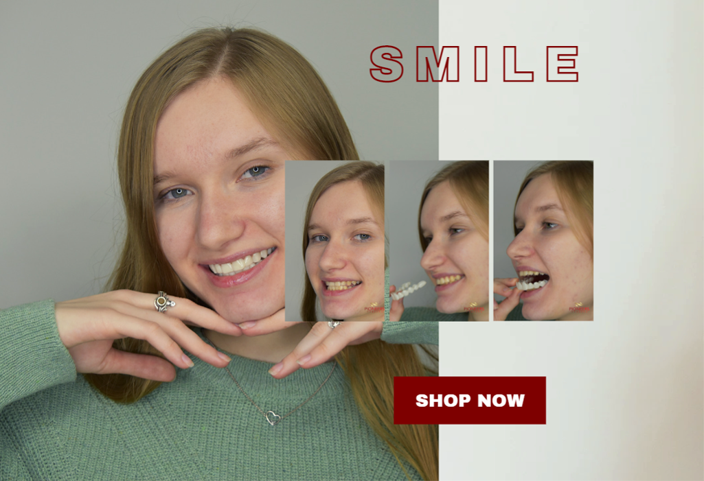 What is the meaning of snap on veneers?