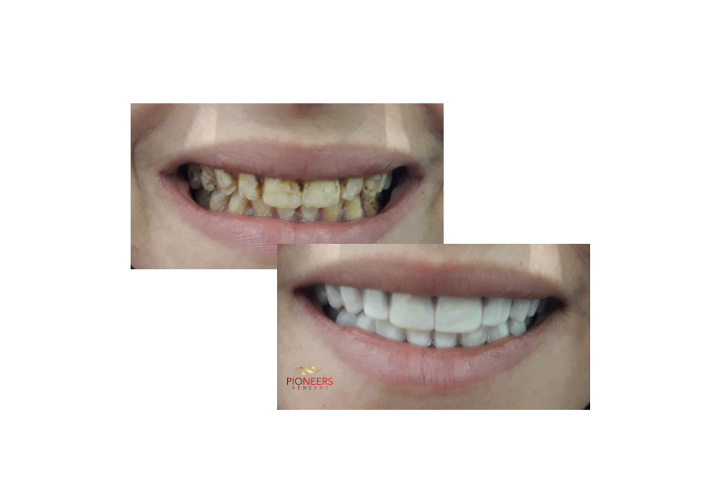 snap on veneers