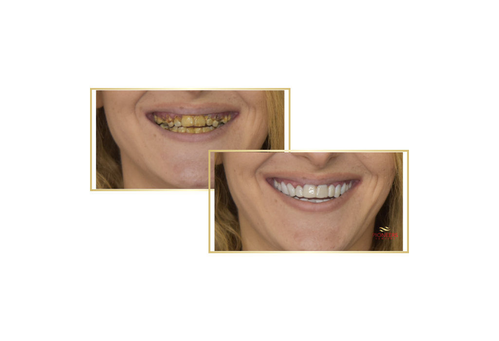 snap on veneers