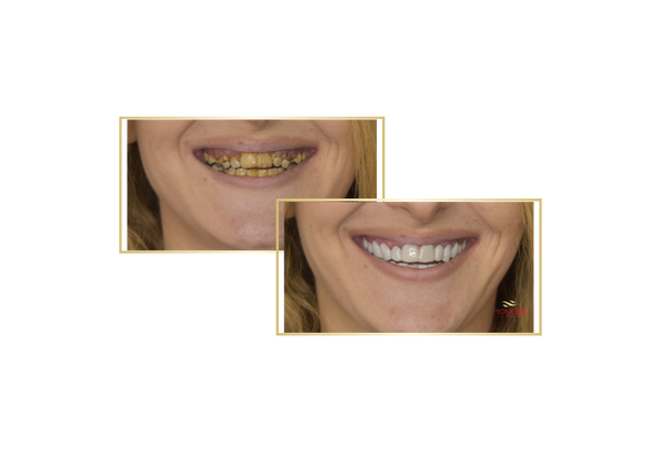 snap on veneers