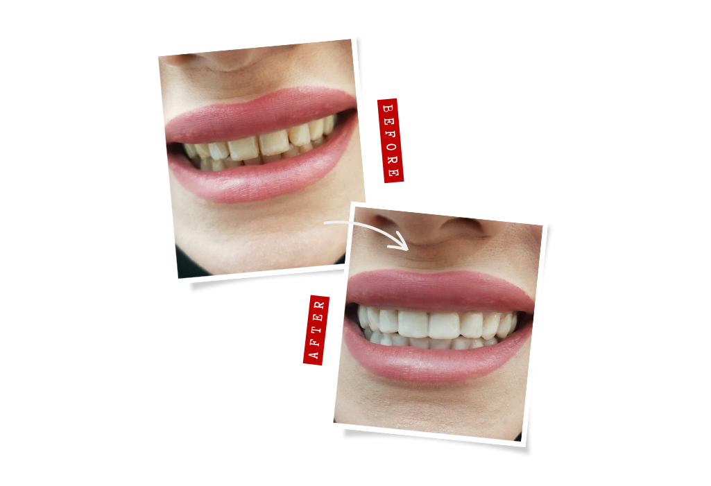 snap on veneers