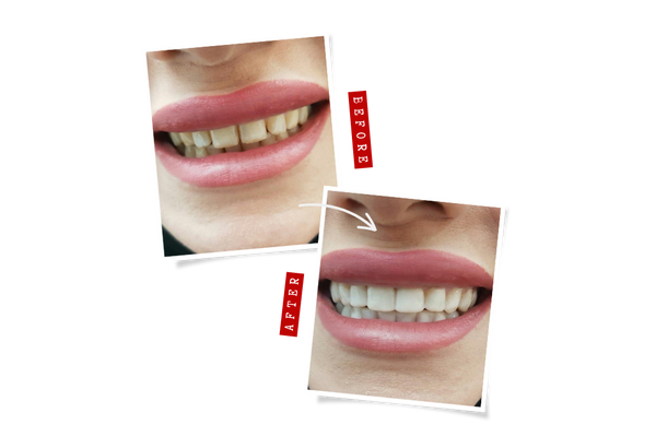snap on veneers