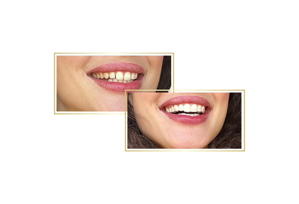 Clip-on veneers