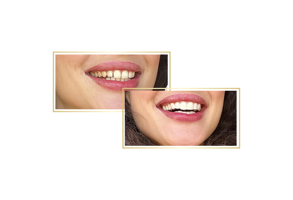 Clip-on veneers