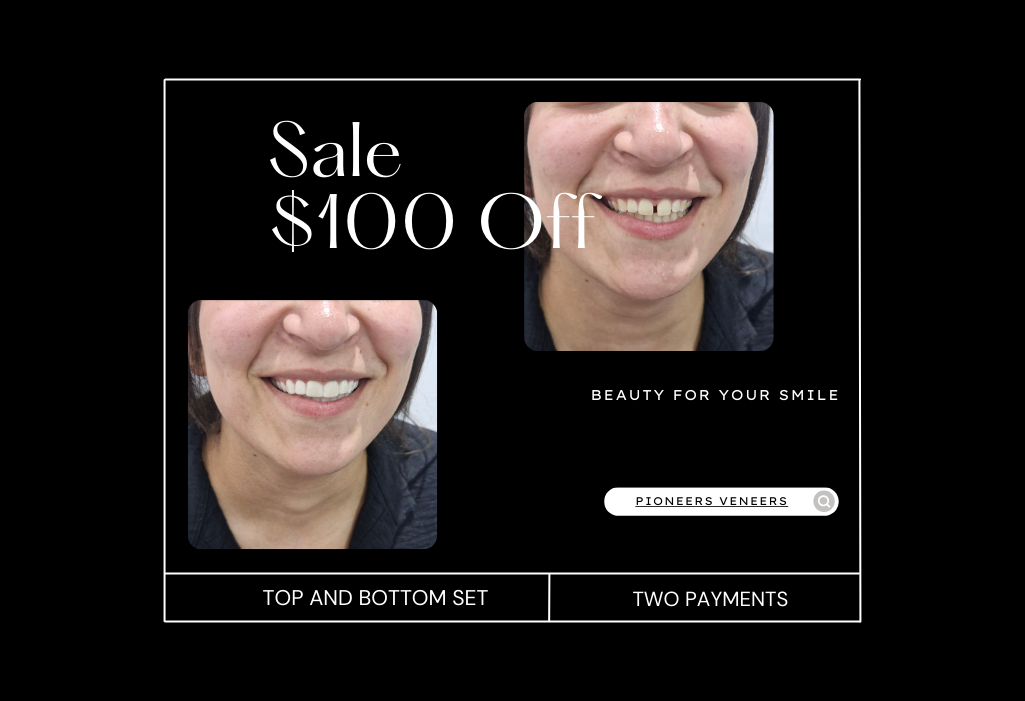 snap on veneers