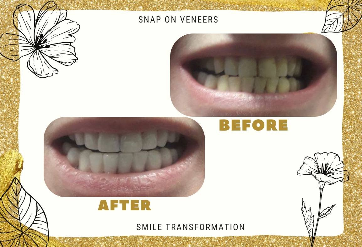 snap on veneers before and after