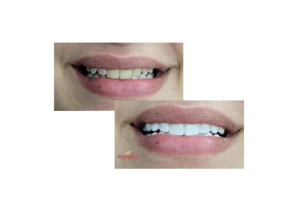 white teeth covers