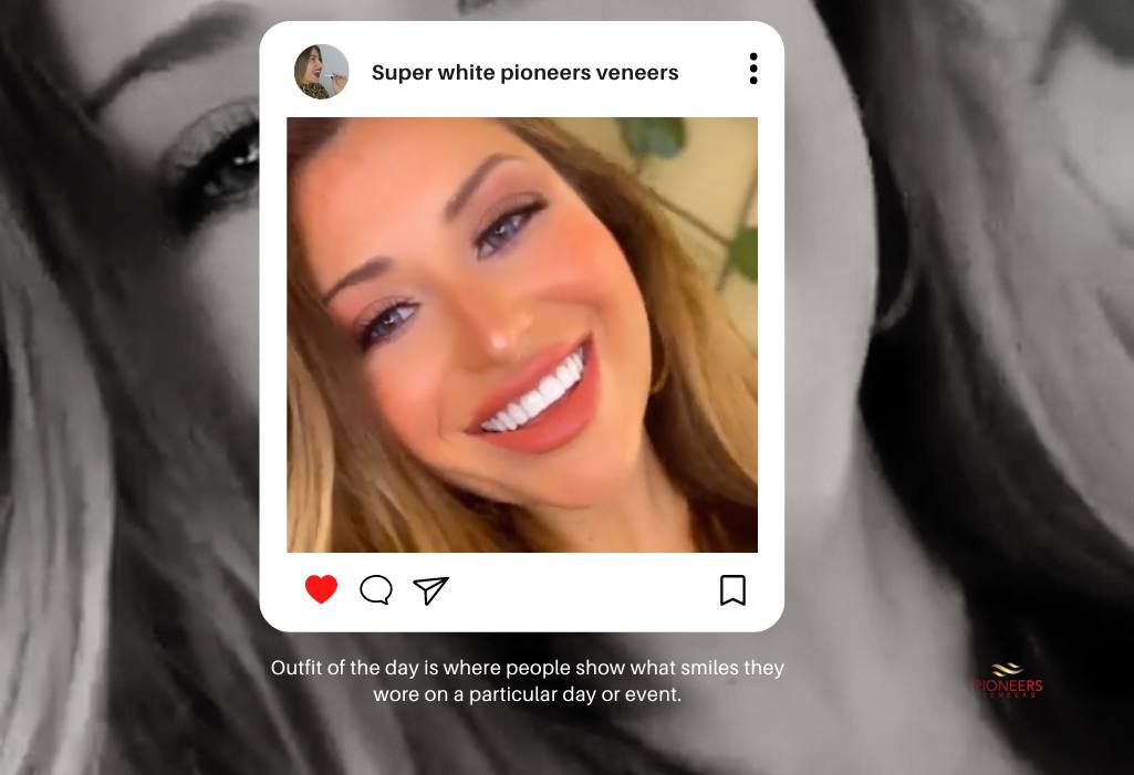 Affordable veneers