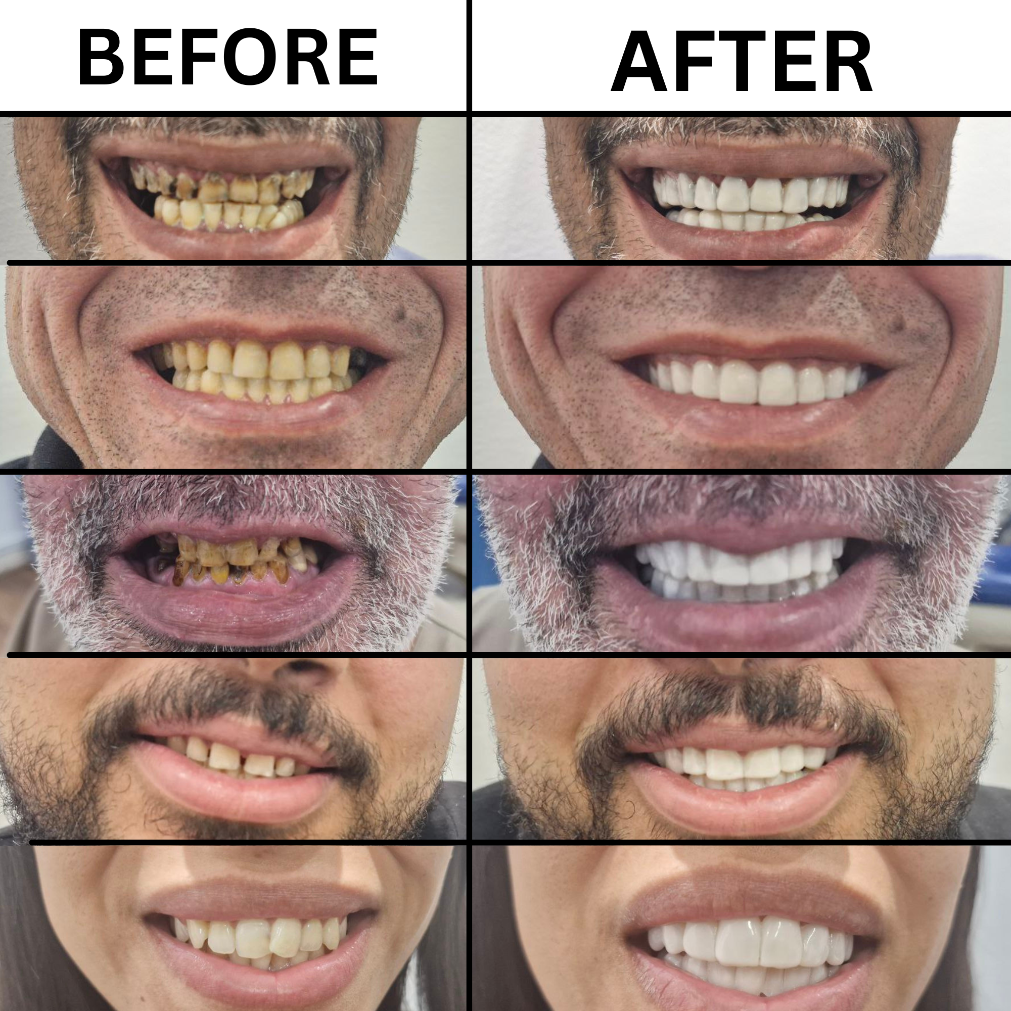 Pioneers Veneers Custom Clip on Veneers (Top, Bottom, or Full Set)