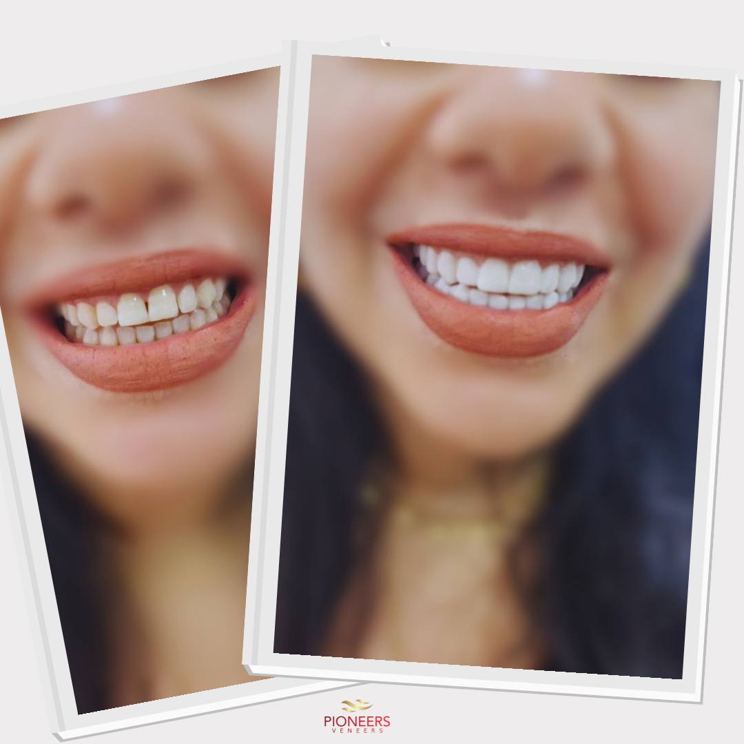 Pioneers Veneers Custom Clip on Veneers (Top, Bottom, or Full Set)