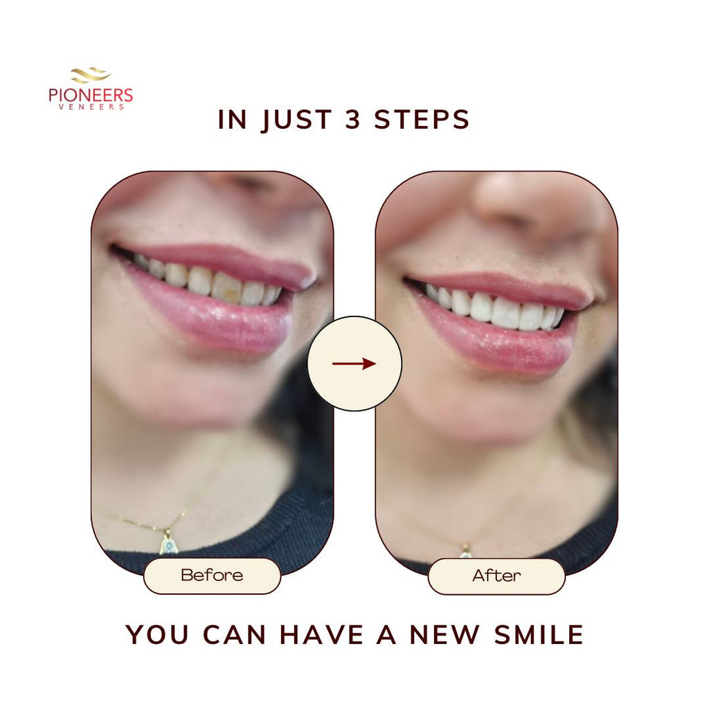 Pioneers Veneers Custom Clip on Veneers (Top, Bottom, or Full Set)