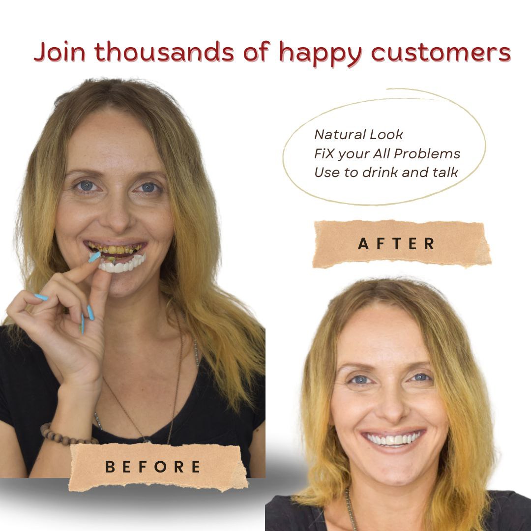 Pioneers Veneers Custom Clip on Veneers (Top, Bottom, or Full Set)