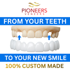 Pioneers Veneers Custom Clip on Veneers