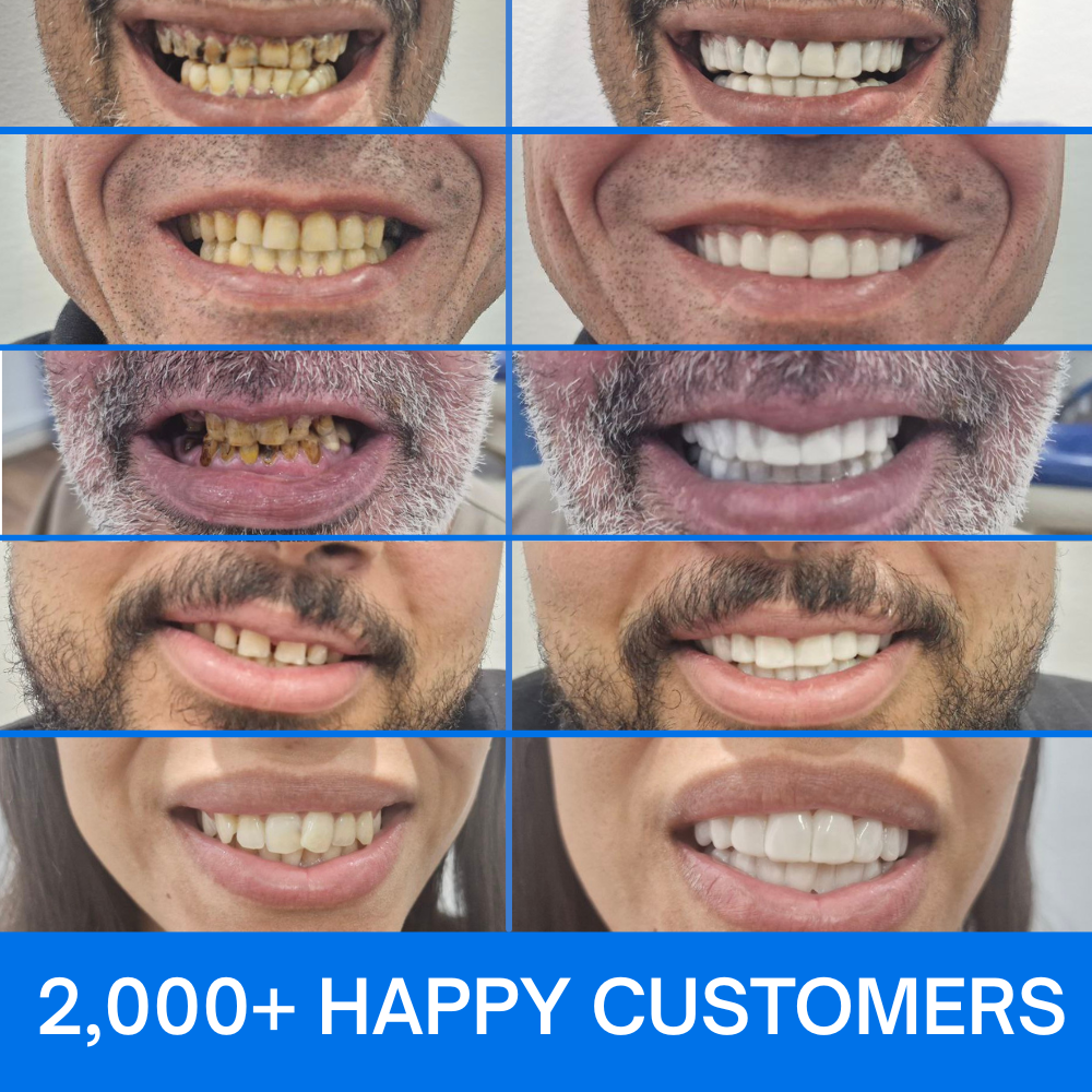 Pioneers Veneers Custom Clip on Veneers (Top, Bottom, or Full Set)